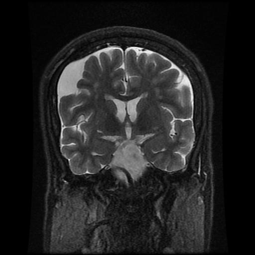 Arachnoid Cyst Frontal Image