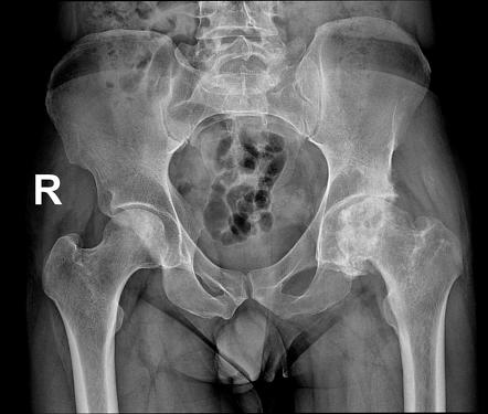 Avascular Necrosis Hip Treatment