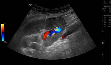 Post renal biopsy arteriovenous fistula and pseudoaneurysm | Image ...