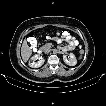 Renal angiomyolipoma | Radiology Case | Radiopaedia.org