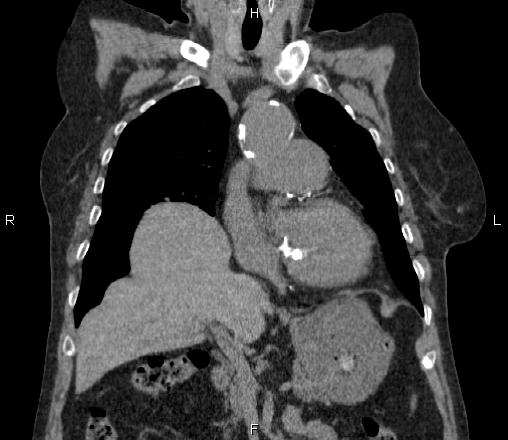 Diaphragmatic Eventration Image