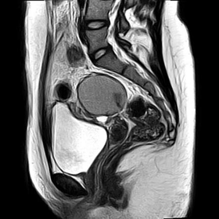 Ovarian endometrioma - T2 dark spot sign | Radiology Case | Radiopaedia.org