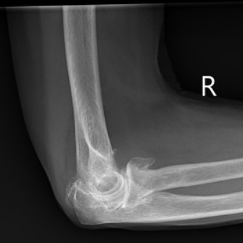 Elbow osteoarthritis | Image | Radiopaedia.org