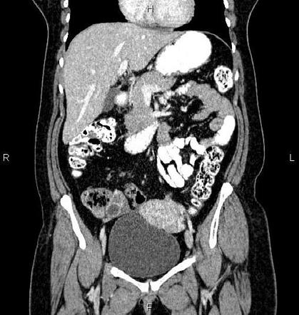 Diastasis recti | Image | Radiopaedia.org