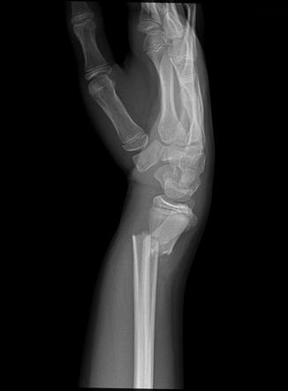 Distal radius and ulna fractures | Radiology Case | Radiopaedia.org