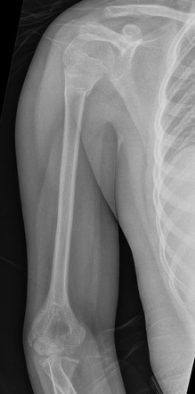 Proximal Humeral Greenstick Fracture Radiology Case Radiopaedia Org