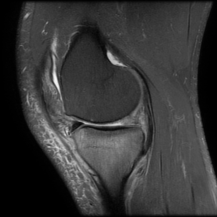 Posterior medial meniscal tear and subchondral insufficiency fracture ...