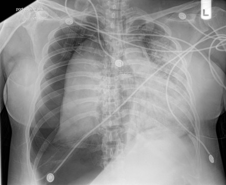 pneumothorax case study scribd