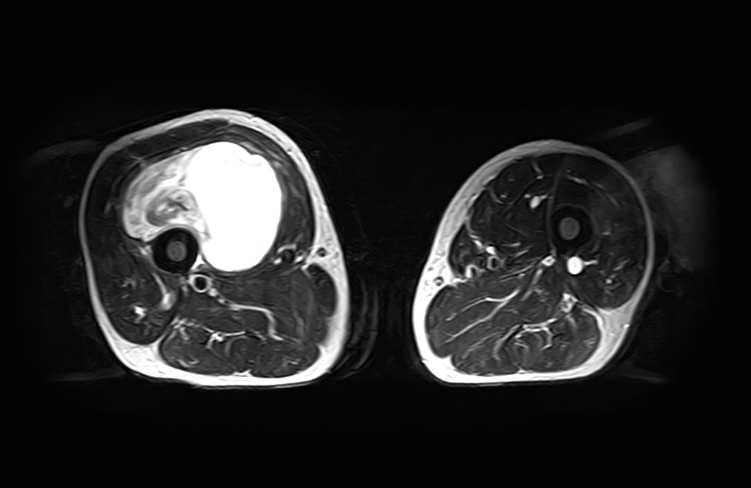 Myxoid liposarcoma - soft tissues | Image | Radiopaedia.org