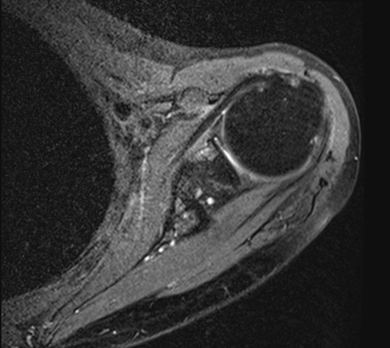 Base of coracoid process fracture | Image | Radiopaedia.org