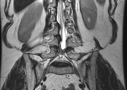 Lumbar arachnoiditis with empty thecal sac sign | Image | Radiopaedia.org