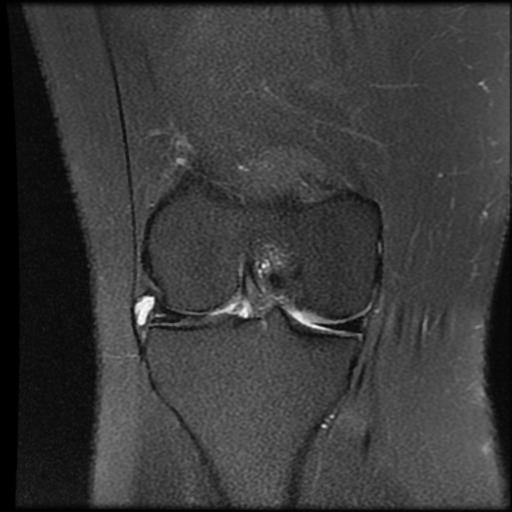 Parameniscal cyst | Image | Radiopaedia.org