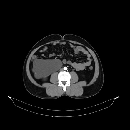 Gross hydronephrosis | Image | Radiopaedia.org