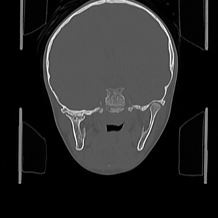 Temporomandibular joint ankylosis | Radiology Case | Radiopaedia.org