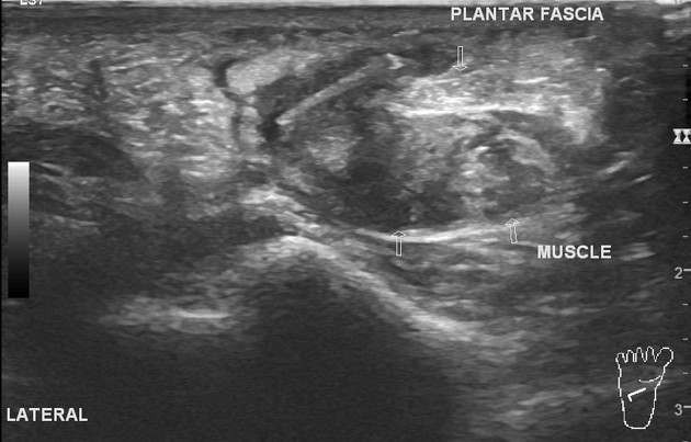 Ultrasound clearance on foot