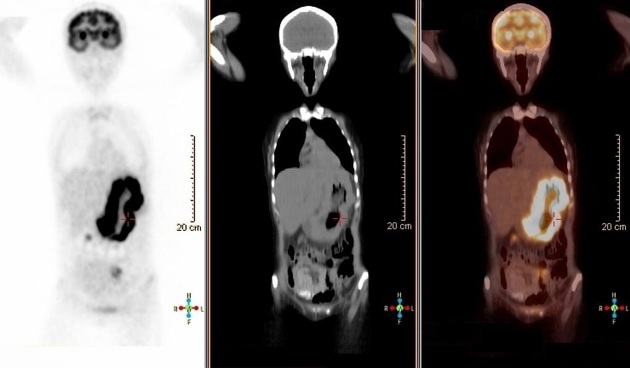 Gastric lymphoma | Radiology Reference Article | Radiopaedia.org