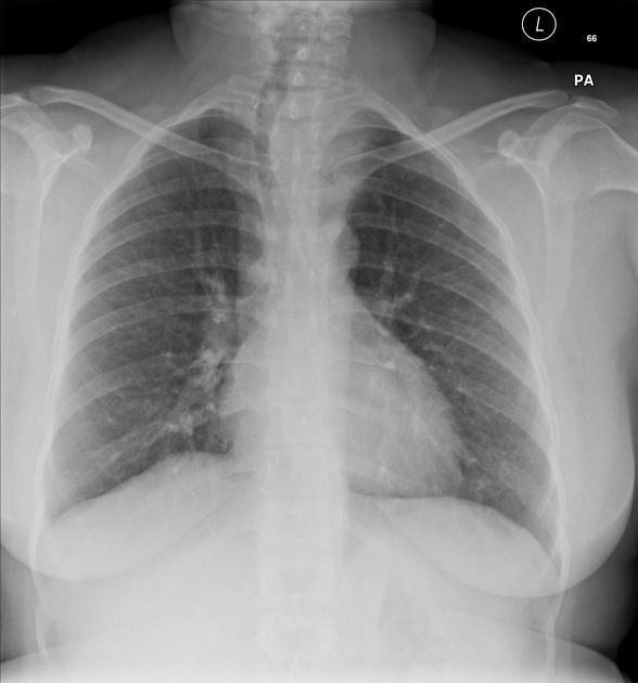 Substernal goiter | Radiology Reference Article | Radiopaedia.org