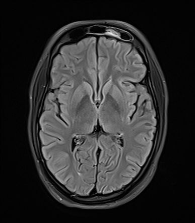 Pituitary macroadenoma with apoplexy | Radiology Case | Radiopaedia.org