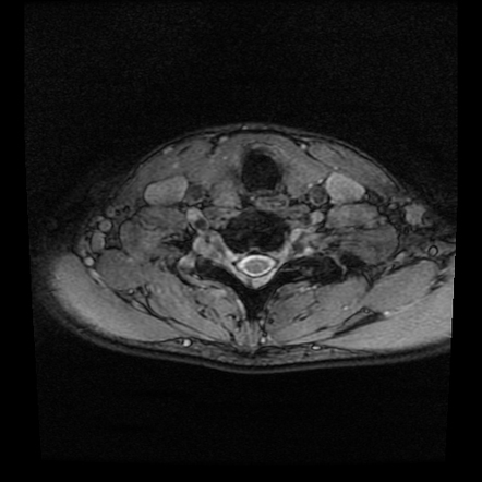 Hirayama disease | Image | Radiopaedia.org