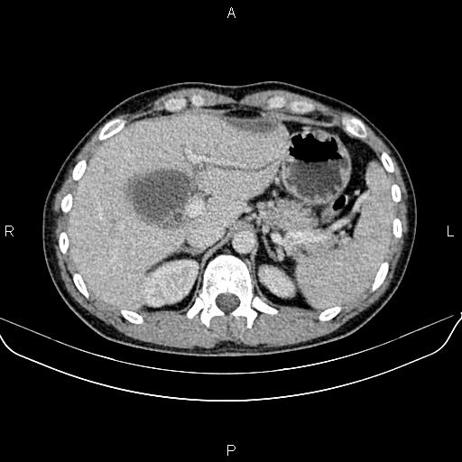 Post cholecystectomy biloma | Image | Radiopaedia.org