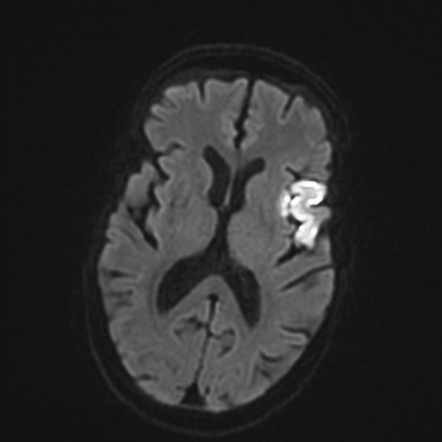 Broca's area infarct | Radiology Case | Radiopaedia.org