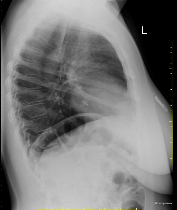 Patent foramen ovale closure device and an insertable cardiac monitor ...