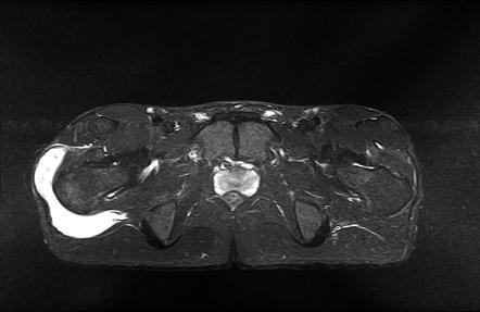 Trochanteric bursitis - post traumatic | Radiology Case | Radiopaedia.org