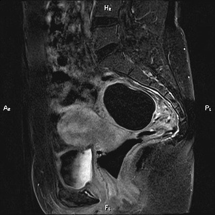 Endometrioza Icd 10