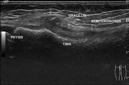 Pes Anserine Bursitis Radiopaedia