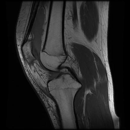 Transient lateral patellar dislocation | Image | Radiopaedia.org