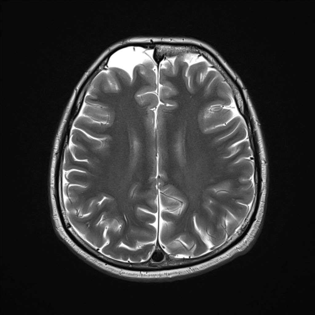 Arachnoid Cyst Image