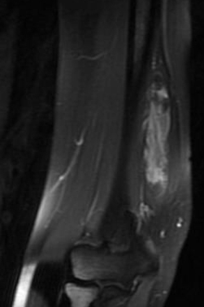 Soft tissue hemangioma - arm | Image | Radiopaedia.org