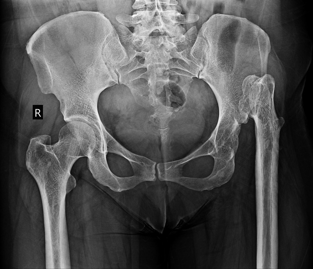 The patient said she felt a lot of pain. I believe her : r/Radiology