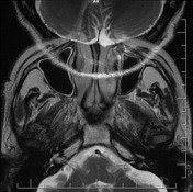 Mri Artifacts Radiology Reference Article Radiopaedia Org