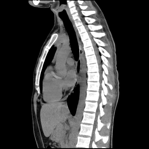 Normal Low Dose Chest Ct Image Radiopaedia Org