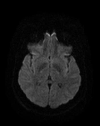 Dysembryoplastic neuroepithelial tumor (DNET) | Image | Radiopaedia.org