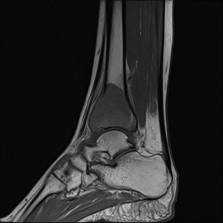 Giant cell tumor with secondary aneurysmal bone cyst | Image ...