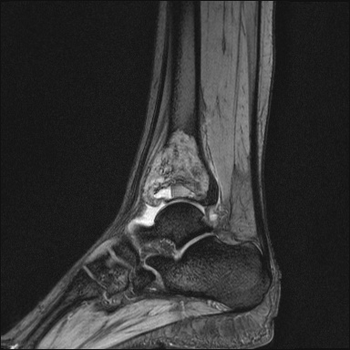 Giant cell tumor with secondary aneurysmal bone cyst | Image ...