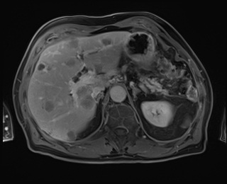 Fluid-fluid levels in hepatic metastases - pancreatic adenocarcinoma ...