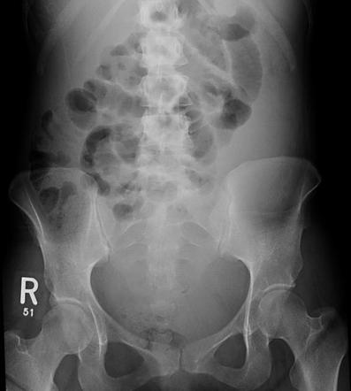 Krukenberg tumor | Image | Radiopaedia.org