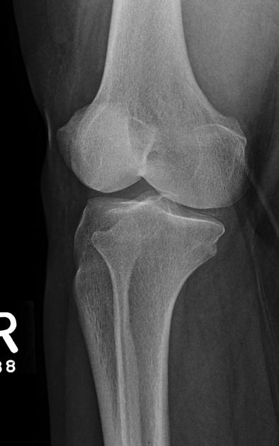 Chondrocalcinosis - knee | Image | Radiopaedia.org