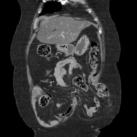 Incisional Hernia Radiology Reference Article Radiopaedia Org