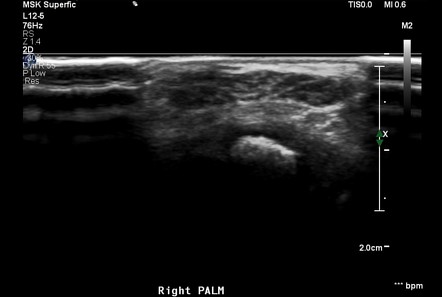 Lipomatosis of nerve | Radiology Reference Article | Radiopaedia.org