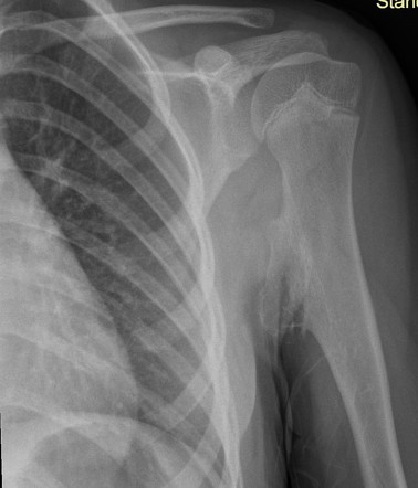 Osteochondroma of humerus | Radiology Case | Radiopaedia.org