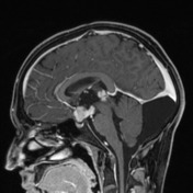 Central nervous system germinoma | Radiology Reference Article ...