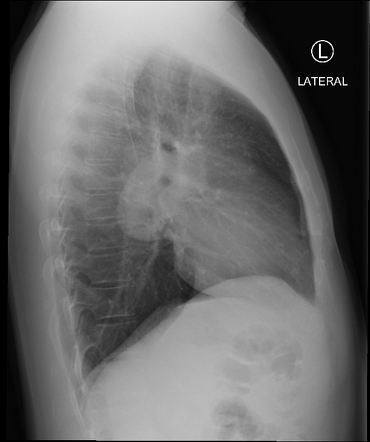 Bronchogenic cyst | Image | Radiopaedia.org