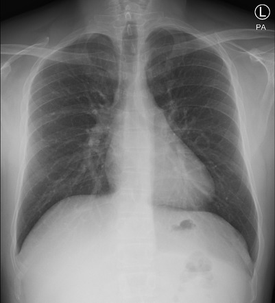 Bronchogenic cyst | Image | Radiopaedia.org