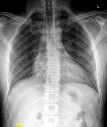 Aspirated foreign body- needle in left upper lobe lung bronchus ...