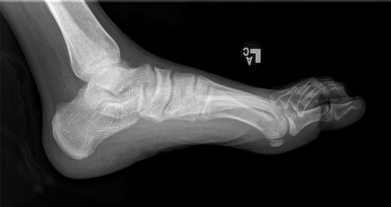 Medullary Bone Infarct - Lupus On Corticosteroids 