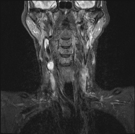 Schwannoma of brachial plexus | Radiology Case | Radiopaedia.org